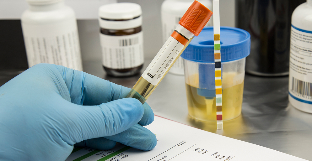 Анализ мочи при цистите — пробирка и диагностические тест-полоски